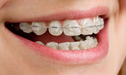 Ceramic Braces - What To Know - Summit Dental & Orthodontics